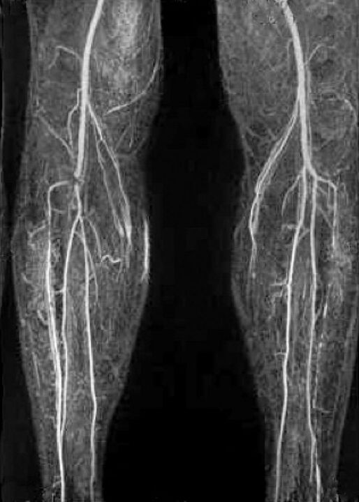Veresoonte x -ray