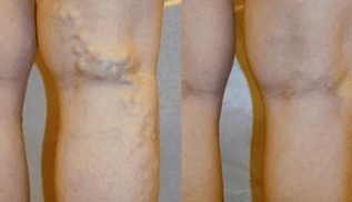 meeste jalgade veenilaiendite nähud ja sümptomid