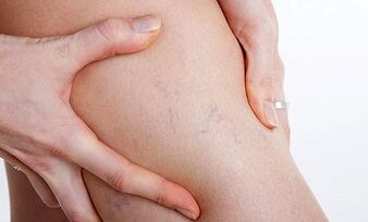 jalgade veenilaiendite tekke põhjused