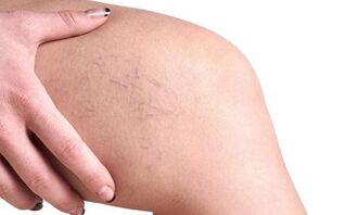 veenilaiendite arenguetapid