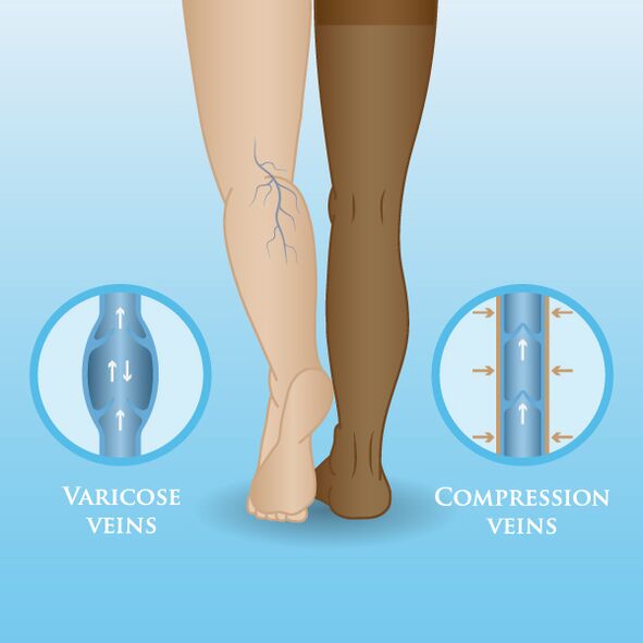 Kompressioonriiete mõju jalgade veenilaienditele