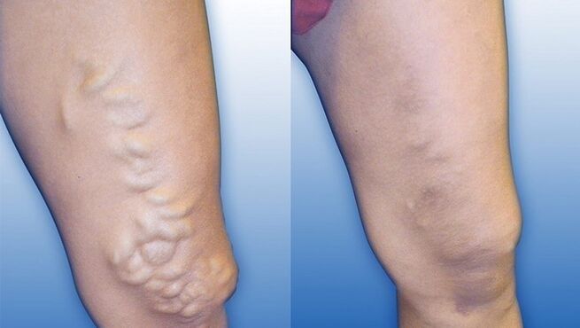 Jalad enne ja pärast raskete veenilaiendite ravi