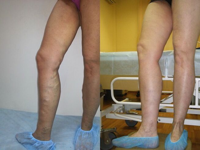 Jalad enne ja pärast veenilaiendite laserravi